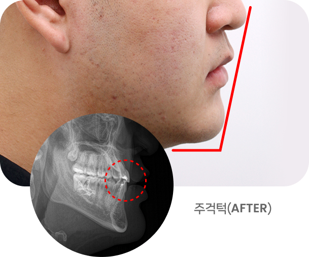 주걱턱 사진4